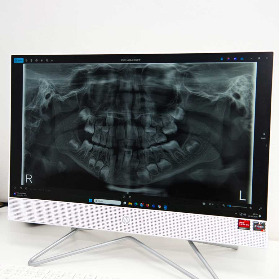 Panoramatický zubní rentgen na monitoru